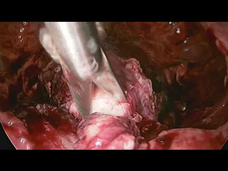 Cervical Ectopic Pregnancy Managed by Laproscopic Surgery