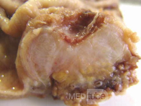Adenocarcinoma of the Antrum and incisura angularis (5 of 12)