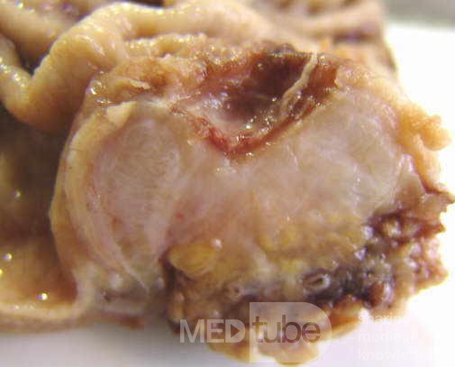 Adenocarcinoma of the Antrum and incisura angularis (5 of 12)