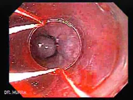 Esophageal Varix - Banding of Varices