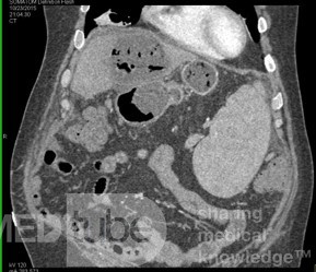 Liver Necrosis