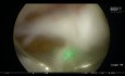 Anatomical Endoscopic Enucleation of Prostate for Benign Prostatic Obstruction - Pulsed ThuLEP