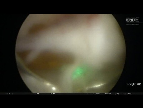 Anatomical Endoscopic Enucleation of Prostate for Benign Prostatic Obstruction - Pulsed ThuLEP