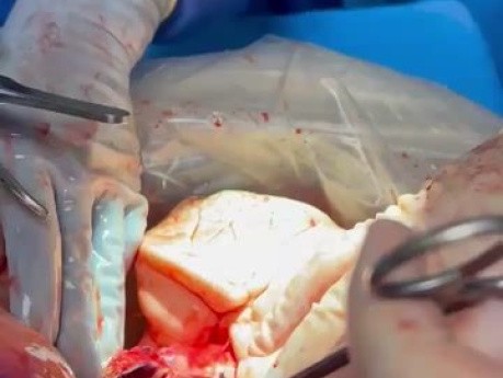 En Block Procurement of Lung Heart and Esophagus Part 1 