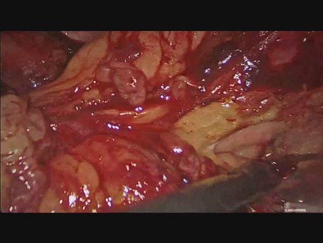 Laparoscopic Distal Pancreatectomy for Unusual Metastatic Lesion in Pancreas