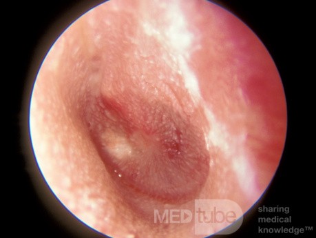 Pinhole Perforation from Acute Otitis Media