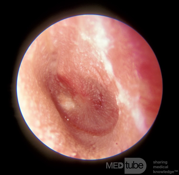 Pinhole Perforation from Acute Otitis Media