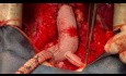 Redo Aortic Root Surgery 4 and the final Video 