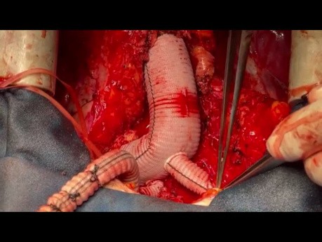 Redo Aortic Root Surgery 4 and the final Video 