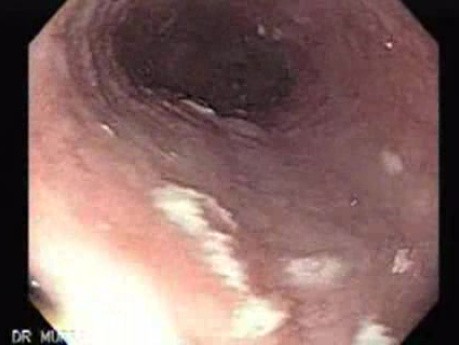 Candida Esophagitis - Endoscopy - Fungal Overgrowth