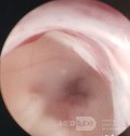 Endoscopic Third Ventriculostomy in a Benign Case of Aicardi Syndrome with Obstructive Hydrocephalus and Chiari Malformation type 1