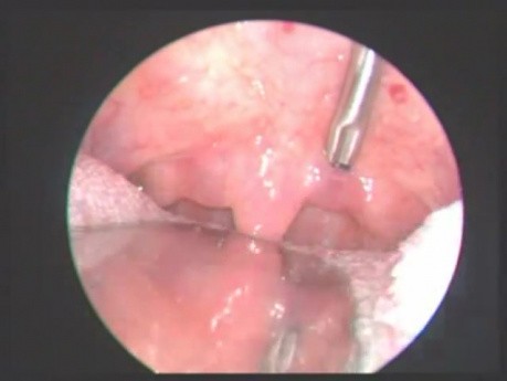 Radiofrequency Procedure as Treatment of Snoring and Mild Obstructive Sleep Apnoea (OSA)
