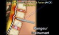 Cervical Spine - Decompression And Fusion