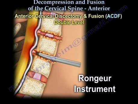 Cervical Spine - Decompression And Fusion
