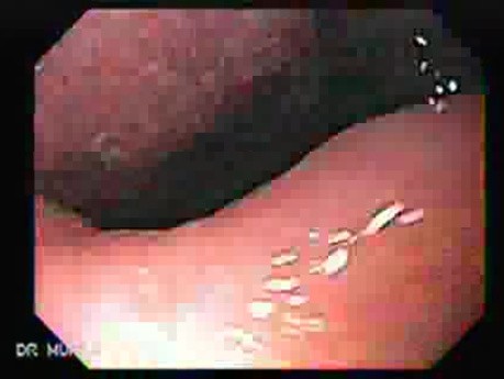 Gastric Lymphoma with Metastases to the Duodenum - Infiltration of the Gastric Angle