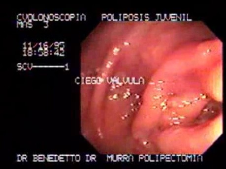 Non Familial Juvenile Polyposis Of The Colon (6 of 37)