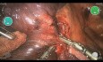 Robotic Right Upper Lobectomy CMR Versius