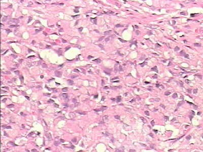 Adenocarcinoma of the cardias and gastric fundus with signet-ring cells (23 of 25)