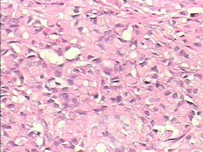 Adenocarcinoma of the cardias and gastric fundus with signet-ring cells (23 of 25)