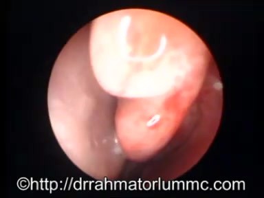 Clefted Concha Bullosa of Middle Turbinate