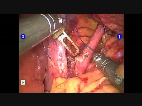 Robotic Hiatal Hernioplasty  