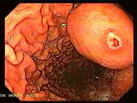 GIST With Ulcerated Lesion (4 of 6)