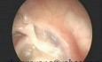 Middle Ear Atelectasis With The Erosion Of Incus And Stapes