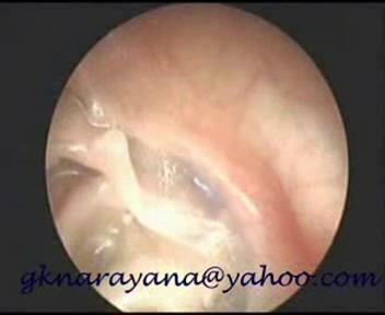 Middle Ear Atelectasis With The Erosion Of Incus And Stapes
