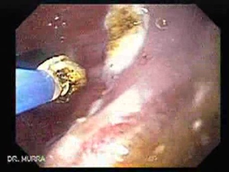 Endoscopic Ablation Of Barrett's Esophagus - 4/6