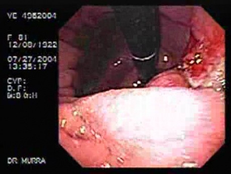 Ulcerative Gastric Adenocarcinoma of the Gastric Angle - Endoscopy