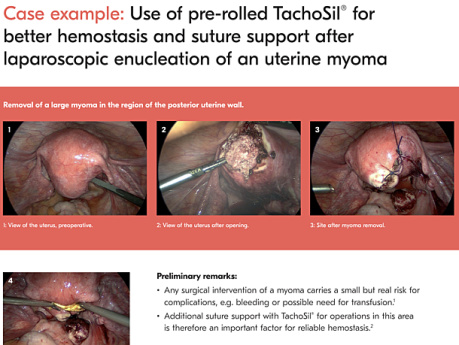 Use of Pre-Rolled TachoSil® for Better Haemostasis and Suture Support After Laparoscopic Enucleation of an Uterine Myoma