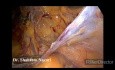 TAPP Herniorrhaphy in Recurrent Right Inguinal Hernia