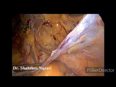 TAPP Herniorrhaphy in Recurrent Right Inguinal Hernia