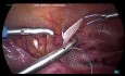 Laparoscopic Hysteropexy for Apical Prolapse