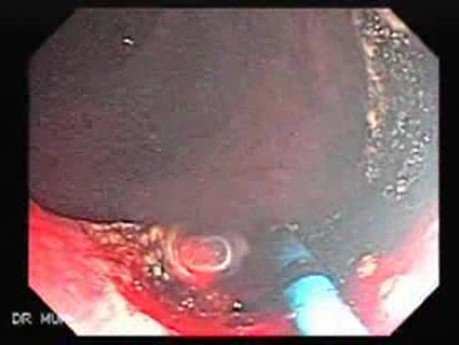 Endoscopic Resection of Giant Tubulo-Villous of the rectum (22 of 35)
