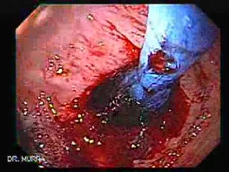 Esophagus - Pneumatic Dilation for Achalasia - Next Stages of This Procedure