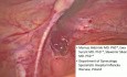 The Use of ICG Method in the Diagnosis of Sentinel Node in Uterine Cancer - preliminary report