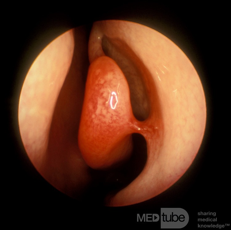 Synechiae