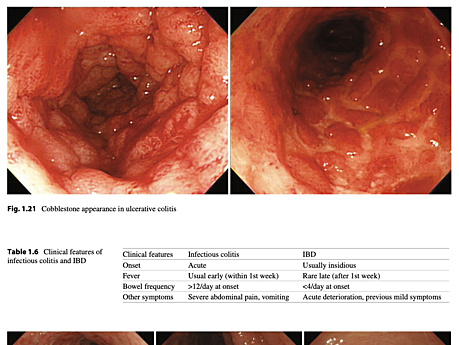 17 Atlas of Inflammatory Bowel Diseases