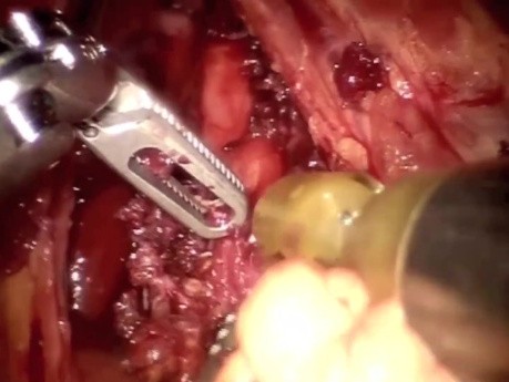 Robotic Repair of Median Arcuate Ligament Syndrome