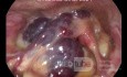 Laryngeal Haemangioma In An Adult Patient