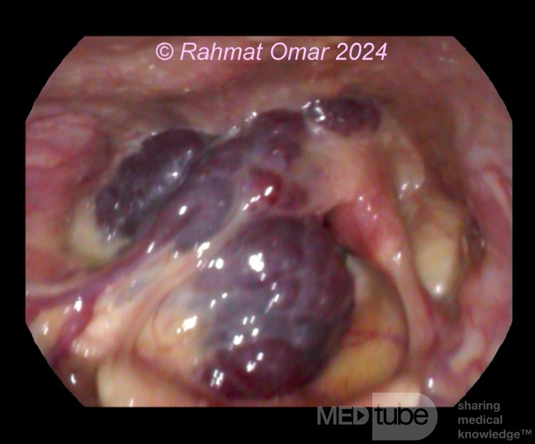 Laryngeal Haemangioma In An Adult Patient