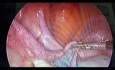 Laparoscopic Opening of Left Fallopian Tube Obstruction