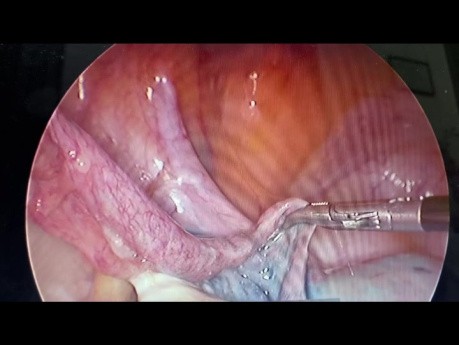 Laparoscopic Opening of Left Fallopian Tube Obstruction