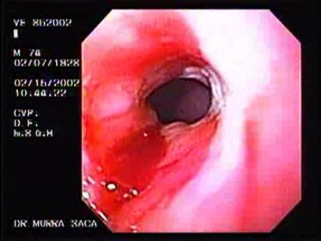 Slight Esophageal Stricture Due To Reflux Esophagitis