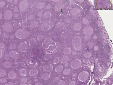 Follicular lymphoma, grade 2 - Histopathology - Lymph node