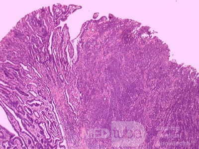 Adenocarcinoma of the Antrum and incisura angularis (10 of 12)