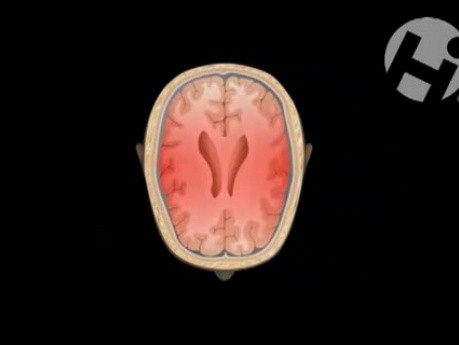 Closed Head Injury with Axonal Shearing