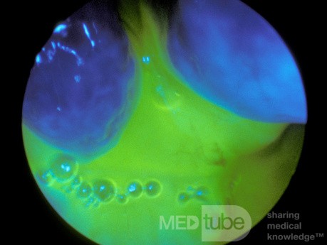 The Fluorescein Test for CSF Rhinorrhea