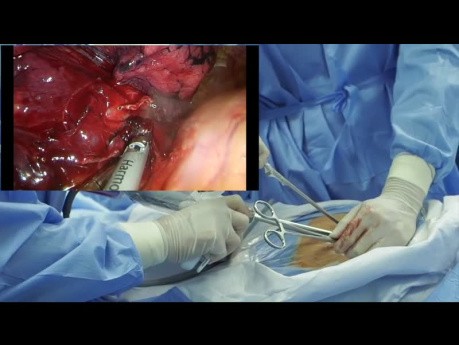 Subcostal Uniportal VATS Instrumentation During Right Upper Lobectomy